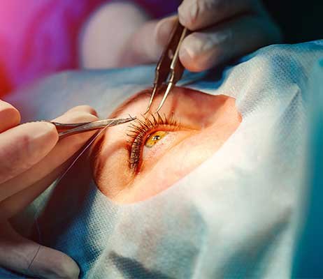 lasik-eye-surgery-dr-brunell-462w